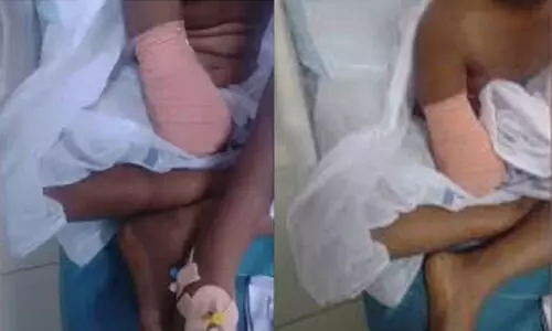 ചികിത്സപ്പിഴവിൽ കൈ മുറിച്ചുമാറ്റപ്പെട്ട ഒമ്പതു വയസ്സുകാരിക്ക് വീണ്ടും ശസ്ത്രക്രിയ വേണ്ടിവന്നേക്കും