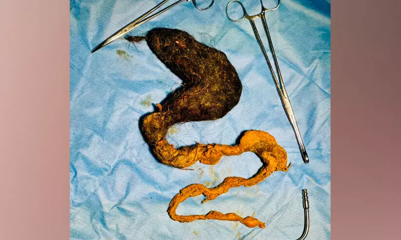 ശസ്ത്രക്രിയയിലൂടെ ട്രൈക്കോബെസോർ നീക്കി