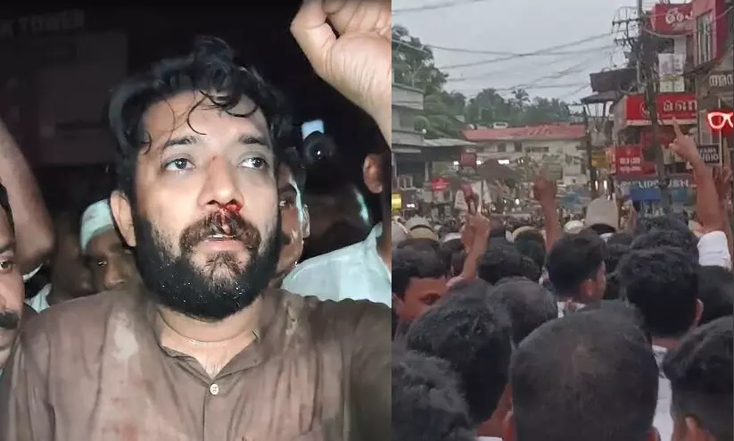 പേരാമ്പ്രയിലെ ലാത്തിചാർജ്: ഷാഫി പറമ്പിലിന്റെ മൂക്കിന്റെ എല്ല് പൊട്ടി; വ്യാപക പ്രതിഷേധവുമായി കോൺഗ്രസ് പേരാമ്പ്രയിലെ ലാത്തിചാർജ്: ഷാഫി പറമ്പിലിന്റെ മൂക്കിന്റെ എല്ല് പൊട്ടി; വ്യാപക പ്രതിഷേധവുമായി കോൺഗ്രസ്