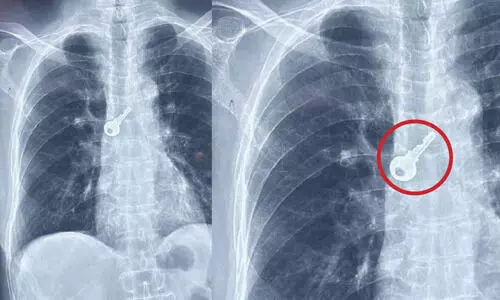 ശ്വാസനാളത്തിൽ കുടുങ്ങിയ താക്കോൽ ശസ്ത്രക്രിയയിലൂടെ പുറത്തെടുത്തു