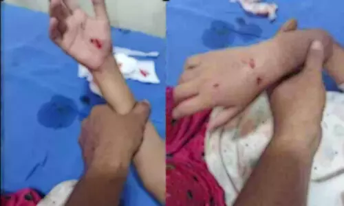 തെ​രു​വു നാ​യ്ക്ക​ളു​ടെ ആ​ക്ര​മ​ണ​ത്തി​ൽ ഒ​മ്പ​തു​കാ​രി​ക്ക് ഗു​രു​ത​ര പ​രി​ക്ക്