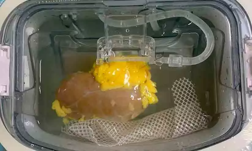 Scientists Create One Kidney That Can Match Any Patient Scientists Create One Kidney That Can Match Any Patient