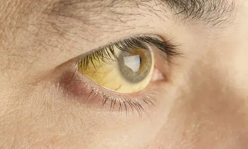 മഞ്ഞപ്പിത്തം പടരുന്നു; ജാഗ്രത വേണമെന്ന് ഡി.എം.ഒ