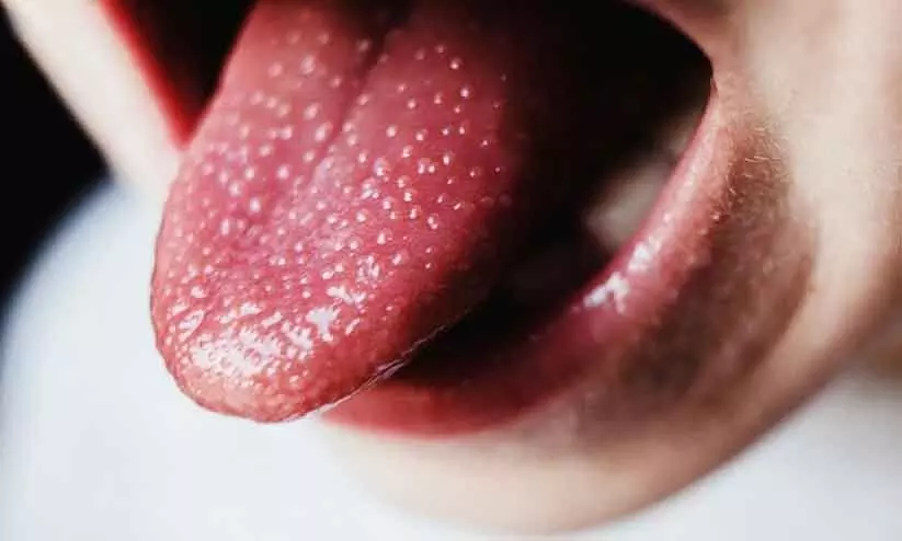 Scarlet fever Scarlet fever