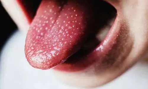 Scarlet fever Scarlet fever