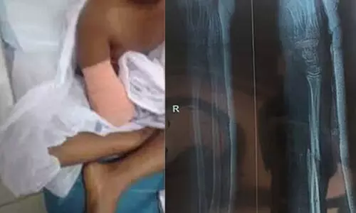 സ്റ്റിച്ചിട്ട ഭാഗത്ത് പഴുപ്പ്; ചികിത്സാ പിഴവിനെ തുടർന്ന് കൈ മുറിച്ചുമാറ്റിയ ഒമ്പതു വയസുകാരിക്ക് വീണ്ടും സർജറി