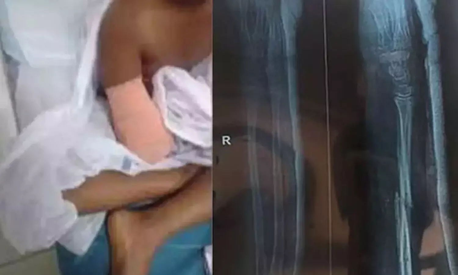 ഒമ്പതുകാരിയുടെ കൈ മുറിച്ച സംഭവം: ഡോക്ടർമാർക്കെതിരെ കേസെടുക്കാൻ ഉത്തരവ്