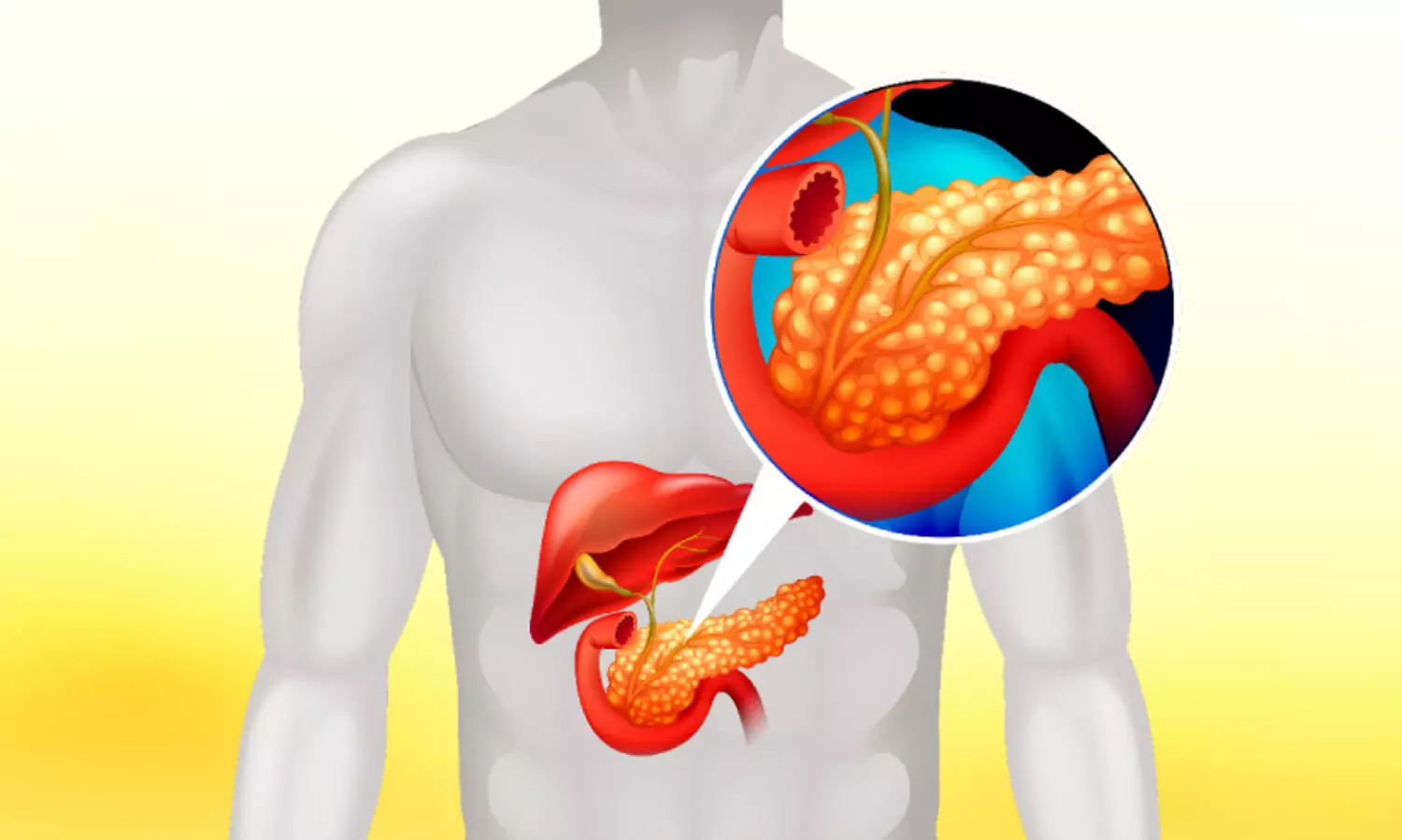 പാ​ൻ​ക്രി​യാ​സ് ക​ല്ലു​ക​ൾ വെ​ല്ലു​വി​ളി​യാ​കു​ന്നോ‍‍?