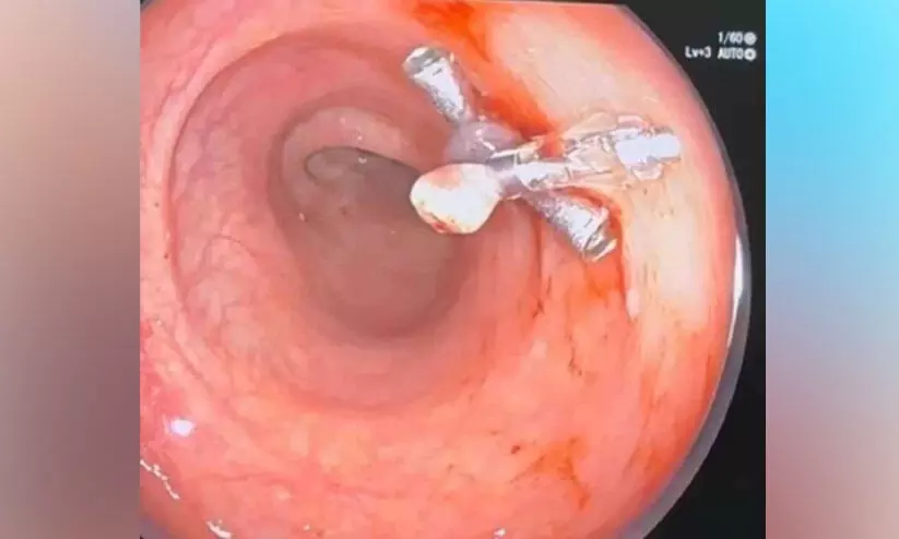 തിരൂർ ജില്ല ആശുപത്രിയിൽ ആദ്യമായി കൊളോനോസ്കോപ്പി വഴി പോളിപെക്ടമി നടന്നു തിരൂർ ജില്ല ആശുപത്രിയിൽ ആദ്യമായി കൊളോനോസ്കോപ്പി വഴി പോളിപെക്ടമി നടന്നു