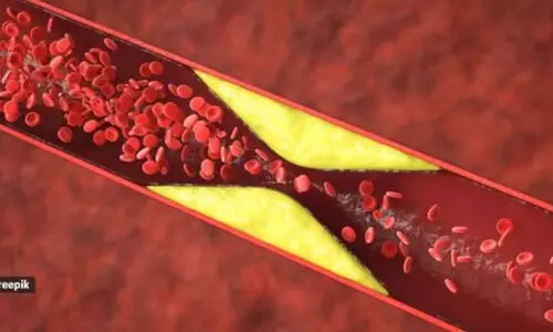 എൽ.ഡി.എൽ കൊളസ്ട്രോൾ 60 ശതമാനം കുറക്കുന്ന മരുന്നിന്റെ പരീക്ഷണം പുരോഗമിക്കുന്നു; ഹൃദയാഘാത സാധ്യത കുറക്കുമെന്ന് വിദഗ്ധർ