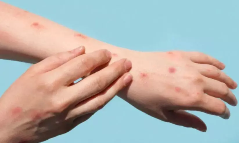 മ​ങ്കി​പോ​ക്സ്; മു​ന്ന​റി​യി​പ്പു​മാ​യി ആ​രോ​ഗ്യ മ​ന്ത്രാ​ല​യം