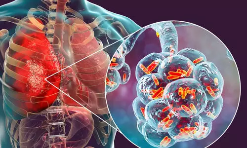 ഇന്ത്യയിൽ ക്ഷയരോഗ കേസുകൾ 21 ശതമാനമായി കുറഞ്ഞു; ഡബ്ല്യു.എച്ച്.ഒ റിപ്പോർട്ട്