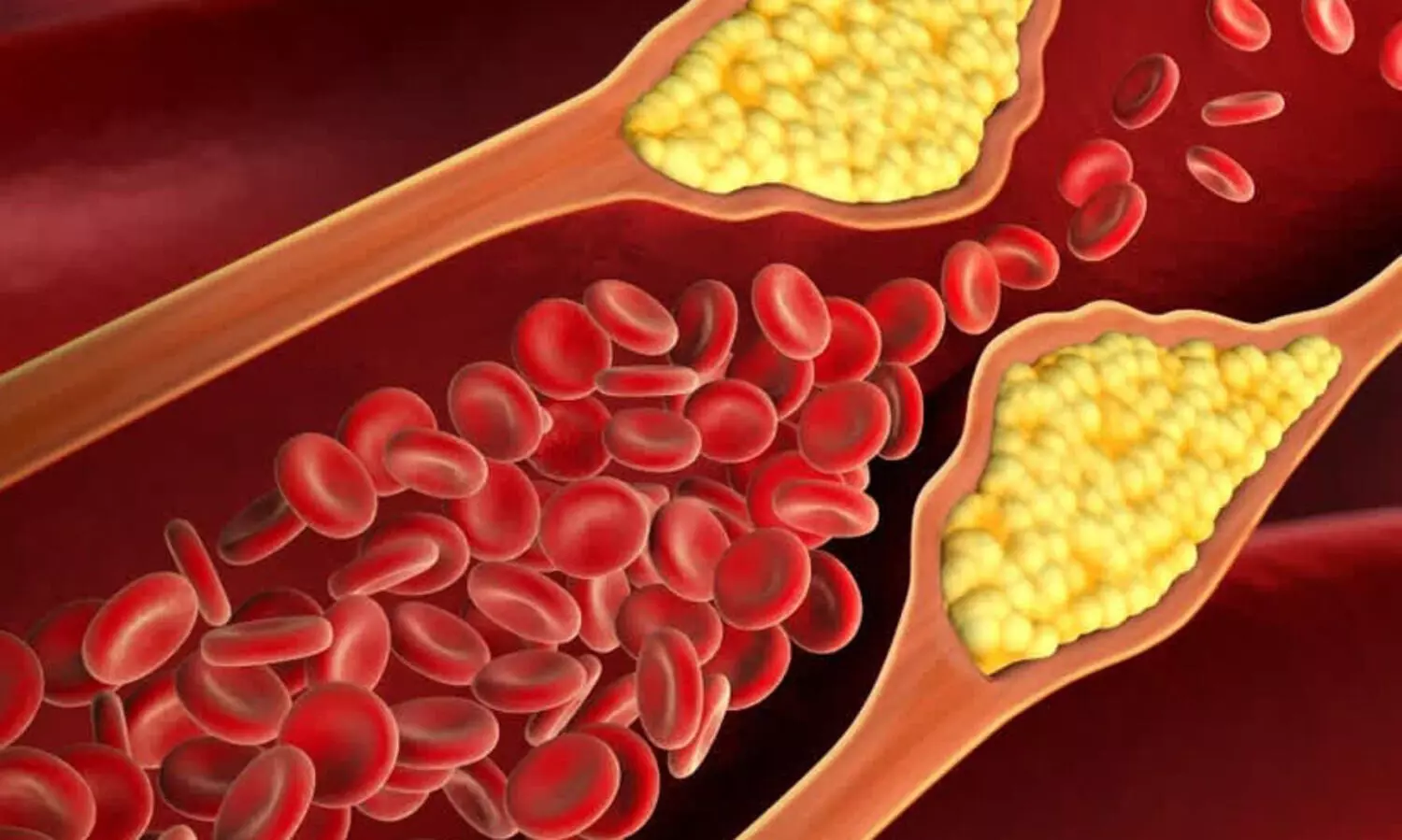 ഹൈ​പ​ർ ടെ​ൻ​ഷ​നും ഹൈ ​കൊ​ള​സ്ട്രോ​ളും