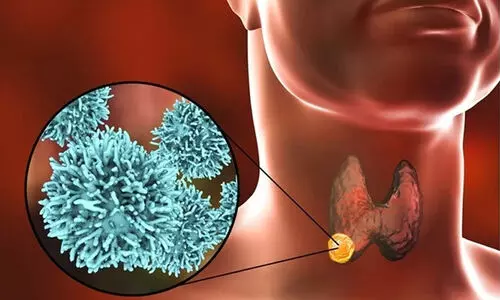 സ്ത്രീകളിൽ തൈറോയ്ഡ് കാൻസർ കൂടുന്നതെന്തുകൊണ്ട്? അമിതവണ്ണമുള്ളവരും ശ്രദ്ധിക്കണം