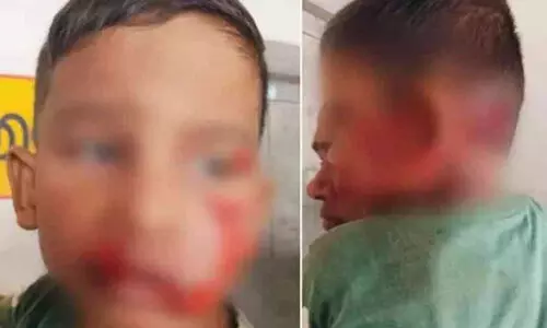 തെരുവുനായ ആക്രമണത്തിൽ പിഞ്ചുകുഞ്ഞുൾപ്പടെ മൂന്ന് പേർക്ക് പരിക്ക്