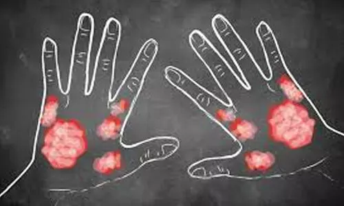 സോ​റി​യാ​സി​സ്; പേ​ടി വേ​ണ്ട, ചി​കി​ത്സ നി​ർ​ബ​ന്ധം