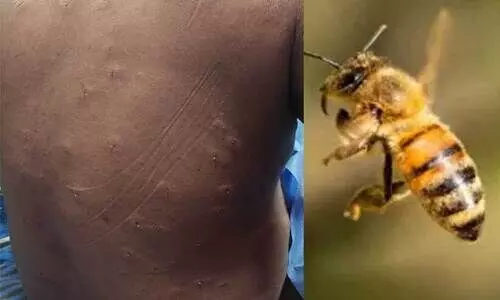 തേനീച്ചയാക്രമണം; യുവാവിന്റെ ശരീരത്തില്‍നിന്ന് നീക്കിയത് 300 തേനീച്ചക്കൊമ്പുകൾ