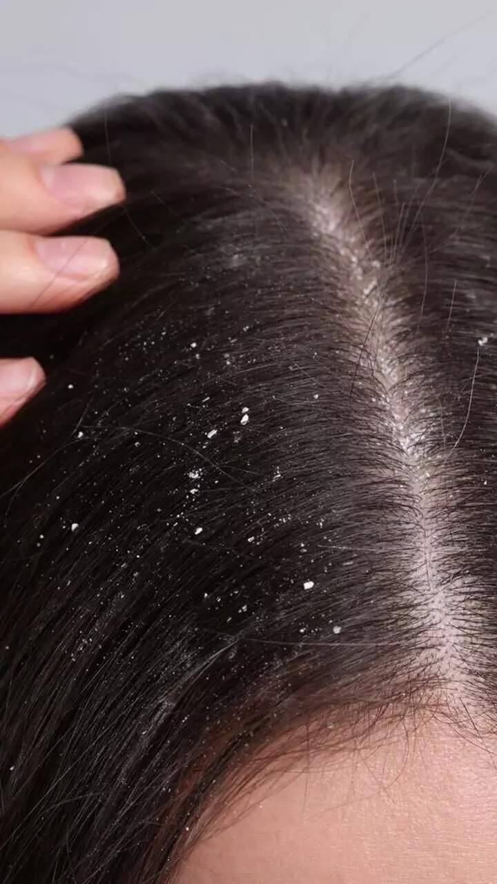 ഒറ്റ രാത്രി കൊണ്ട് താരൻ അകറ്റാം ഒറ്റ രാത്രി കൊണ്ട് താരൻ അകറ്റാം