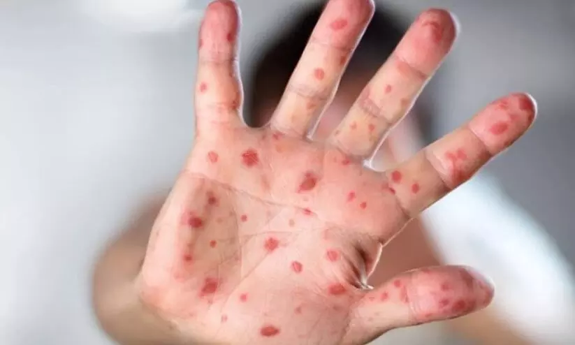 കുട്ടികളിലെ തക്കാളിപ്പനി നിസ്സാരമല്ല; മാതാപിതാക്കൾ അറിയാൻ... കുട്ടികളിലെ തക്കാളിപ്പനി നിസ്സാരമല്ല; മാതാപിതാക്കൾ അറിയാൻ...