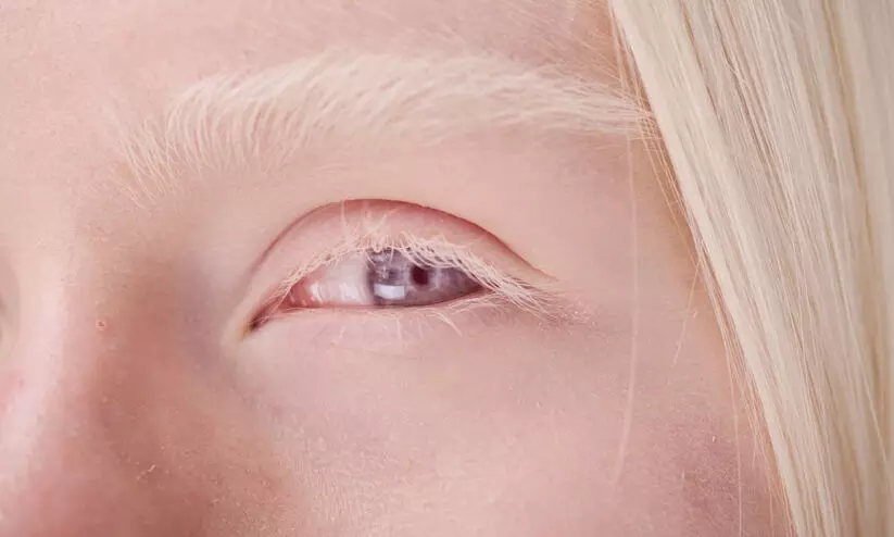 Albinism Albinism