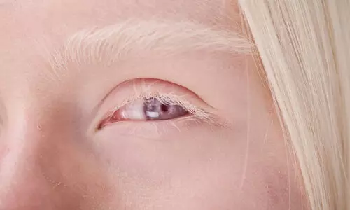 Albinism Albinism