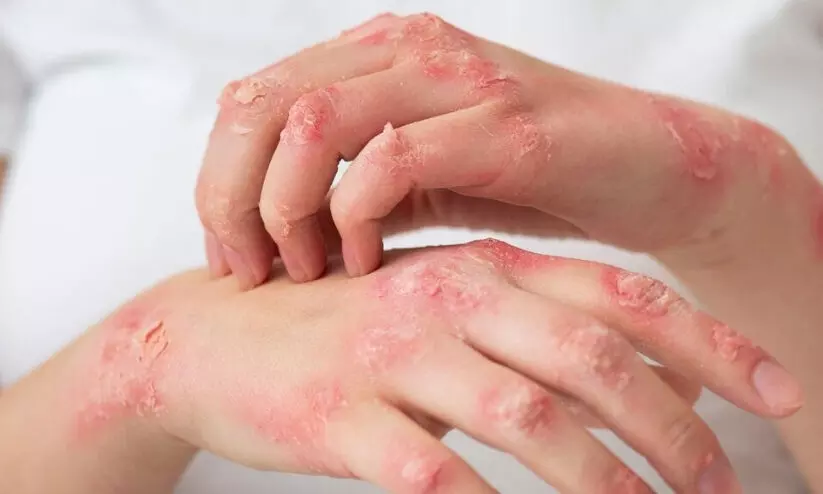 ഭയം വേണ്ട ജാഗ്രത മതി; കുഷ്ഠരോഗികൾക്കൊപ്പം താമസിച്ചാൽ രോഗം പകരുമോ? ഭയം വേണ്ട ജാഗ്രത മതി; കുഷ്ഠരോഗികൾക്കൊപ്പം താമസിച്ചാൽ രോഗം പകരുമോ?