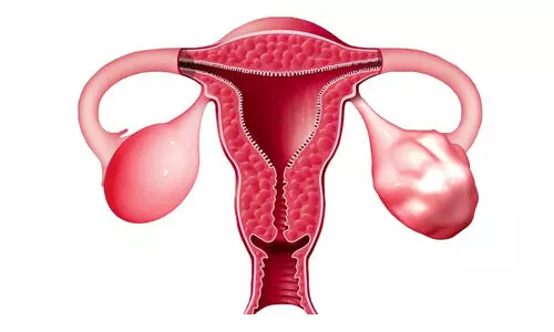 സ്ത്രീകളിലെ ഹോർമോൺ വ്യതിയാനം; പി.സി.ഒ.ഡിയെ പേടിക്കേണ്ടതില്ല