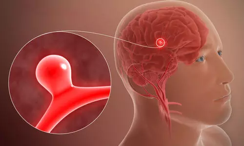 നിശബ്ദ കൊലയാളിയായി മാറുന്ന ബ്രെയിൻ അന്യൂറിസം; തിരിച്ചറിയാം ലക്ഷണങ്ങൾ