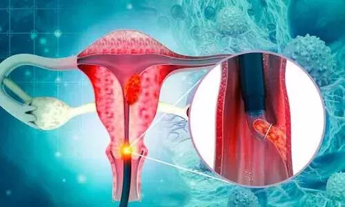 25 വയസ്സ് കഴിഞ്ഞ സ്ത്രീകളാണോ നിങ്ങൾ? എങ്കിൽ നിർബന്ധമായും ഈ പരിശോധന നടത്തിയിരിക്കണം 25 വയസ്സ് കഴിഞ്ഞ സ്ത്രീകളാണോ നിങ്ങൾ? എങ്കിൽ നിർബന്ധമായും ഈ പരിശോധന നടത്തിയിരിക്കണം