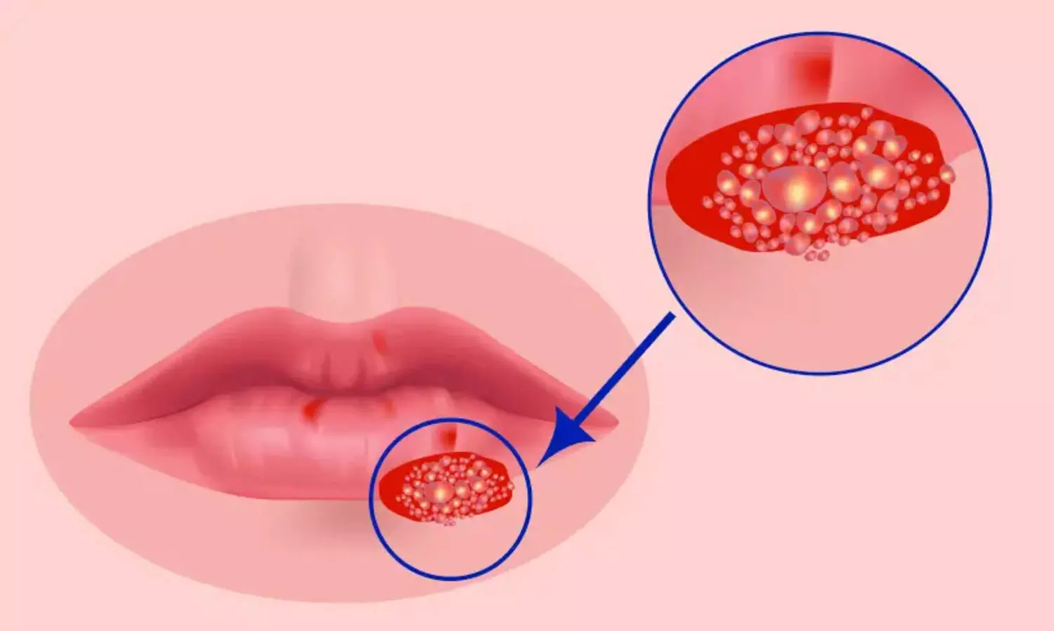 ഹെർപ്പിസും ചിക്കൻപോക്സും ഒന്നാണോ? മുൻകരുതലുകൾ എന്തൊക്കെ?