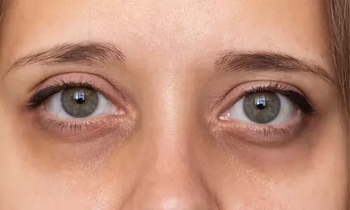 കണ്ണിന് താഴെ കറുപ്പാണോ? ഉറക്കമില്ലായ്മ മാത്രമല്ല കാരണം... കണ്ണിന് താഴെ കറുപ്പാണോ? ഉറക്കമില്ലായ്മ മാത്രമല്ല കാരണം...