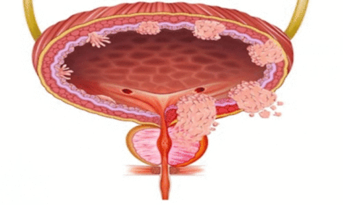 ഏറെ നേരം മൂത്രം പിടിച്ചു വെക്കാറുണ്ടോ? എങ്കിൽ സൂക്ഷിക്കുക ഏറെ നേരം മൂത്രം പിടിച്ചു വെക്കാറുണ്ടോ? എങ്കിൽ സൂക്ഷിക്കുക