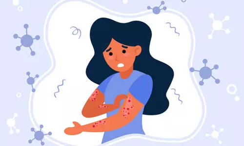 ചി​ക്ക​ന്‍പോ​ക്‌​സ് ജാ​ഗ്ര​ത നി​ർ​​ദേ​ശ​വു​മാ​യി ആ​രോ​ഗ്യ വ​കു​പ്പ്