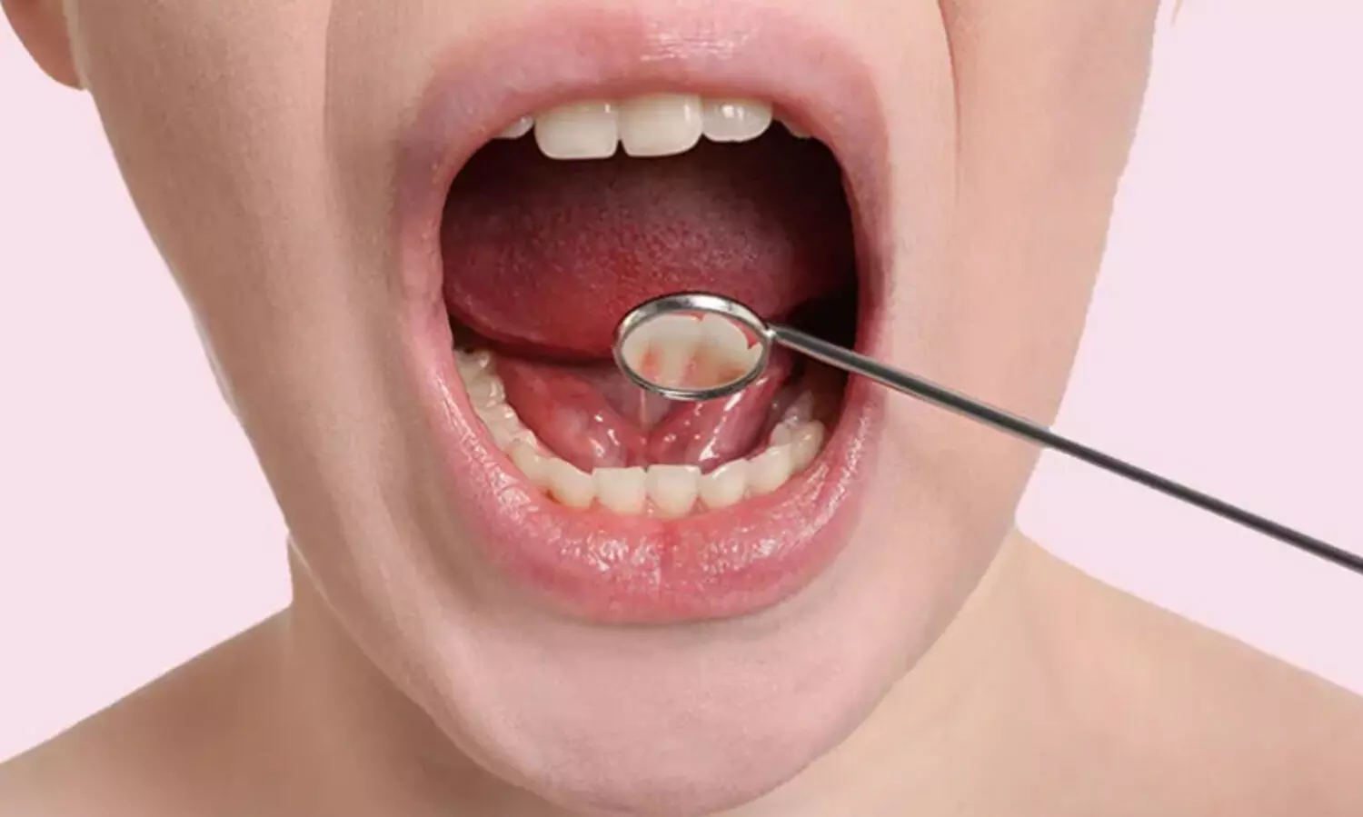 ഒരു വായ്പുണ്ണല്ലേ, തനിയെ മാറിക്കോളും എന്ന് പറയാൻ വരട്ടെ; ചിലപ്പോൾ കാൻസർ ആവാം!