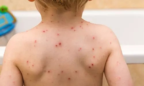 സംസ്ഥാനത്ത് ചിക്കൻ പോക്സ് ബാധിതരുടെ എണ്ണം വർധിക്കുന്നു; കഴിഞ്ഞ ഒന്നര മാസത്തിനിടെ രോഗം സ്ഥിരീകരിച്ചത് 5791 പേർക്ക്