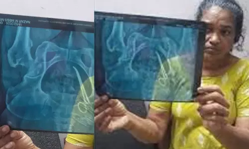 വയറ്റില്‍ കത്രികയുമായി അഞ്ച് വര്‍ഷം തീരാ വേദനയുമായി വീട്ടമ്മ; ആലപ്പുഴ മെഡിക്കല്‍ കോളജിനെതിരെ ഗുരുതര പരാതി