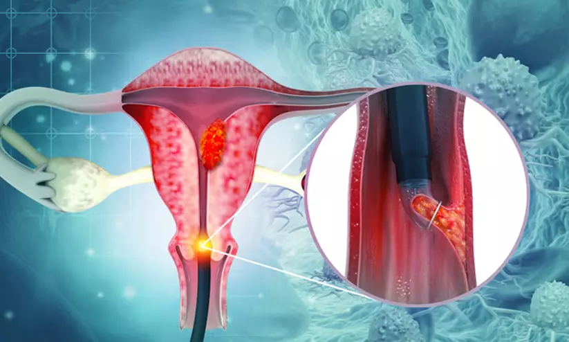 രാജ്യത്ത് ഓരോ എട്ട് മിനിറ്റിലും ഒരാൾ വീതം ഗര്ഭാശയ കാൻസർ ബാധിച്ച് മരിക്കുന്നു; തടയാനുള്ള അഞ്ച് പ്രധാന വഴികൾ രാജ്യത്ത് ഓരോ എട്ട് മിനിറ്റിലും ഒരാൾ വീതം ഗര്ഭാശയ കാൻസർ ബാധിച്ച് മരിക്കുന്നു; തടയാനുള്ള അഞ്ച് പ്രധാന വഴികൾ
