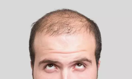 മുടി കൊഴിയുന്നതിന് പ്രായവും പാരമ്പര്യവും മാത്രമല്ല, ചില ശീലങ്ങളും കാരണമാവാം! മുടി കൊഴിയുന്നതിന് പ്രായവും പാരമ്പര്യവും മാത്രമല്ല, ചില ശീലങ്ങളും കാരണമാവാം!