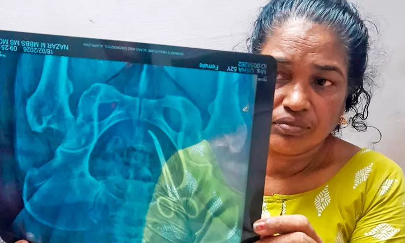 അഞ്ചുവർഷം തിന്ന വേദനക്ക് കയ്യുംകണക്കുമില്ല; വയറ്റിൽനിന്ന് കത്രിക പുറത്തെടുത്ത ആശ്വാസത്തോടെ ഉഷ ആശുപത്രിവിട്ടു അഞ്ചുവർഷം തിന്ന വേദനക്ക് കയ്യുംകണക്കുമില്ല; വയറ്റിൽനിന്ന് കത്രിക പുറത്തെടുത്ത ആശ്വാസത്തോടെ ഉഷ ആശുപത്രിവിട്ടു