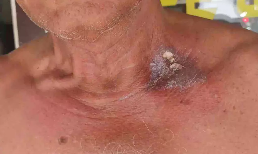 വാൽക്കുളമ്പിൽ വയോധികന് സൂര്യാഘാതമേറ്റു വാൽക്കുളമ്പിൽ വയോധികന് സൂര്യാഘാതമേറ്റു