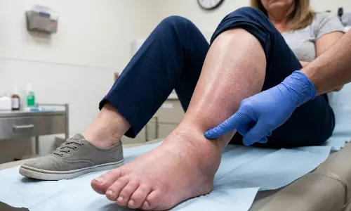 ഒരു കാലിൽ മാത്രമാണോ വീക്കം, കഠിനമായ വേദനയുണ്ടോ? എങ്കിൽ സൂക്ഷിക്കണം; രക്തം കട്ടപിടിക്കാനും സാധ്യത