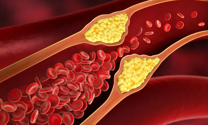 ഹൃദയാരോഗ്യത്തിന് പുതിയ മാർഗനിർദേശങ്ങൾ; കൊളസ്ട്രോൾ പരിശോധന ഇനി നേരത്തെ തുടങ്ങണം എന്ന് പഠനങ്ങൾ ഹൃദയാരോഗ്യത്തിന് പുതിയ മാർഗനിർദേശങ്ങൾ; കൊളസ്ട്രോൾ പരിശോധന ഇനി നേരത്തെ തുടങ്ങണം എന്ന് പഠനങ്ങൾ