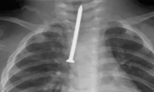 ശ്വാസനാളത്തിൽ കുടുങ്ങിയ അഞ്ച് സെ.മീ നീളമുള്ള ആണി പുറത്തെടുത്തു; എട്ടുമാസം പ്രായമുള്ള കുഞ്ഞിന് റിയാദിൽ പുതുജീവൻ