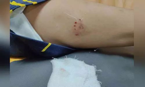 നായുടെ കടിയേറ്റ് എട്ടുവയസ്സുകാരന് പരിക്ക്