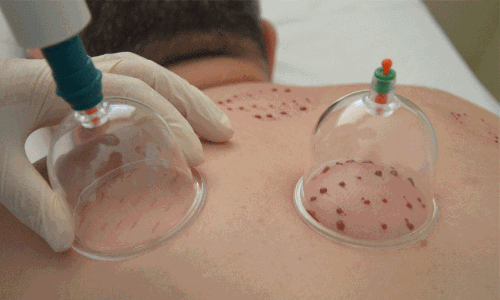 ‘ഹിജാമ’ ചികിത്സയിൽ തേൻ ഉപയോഗിക്കുന്നതിനെതിരെ മുന്നറിയിപ്പ് ‘ഹിജാമ’ ചികിത്സയിൽ തേൻ ഉപയോഗിക്കുന്നതിനെതിരെ മുന്നറിയിപ്പ്