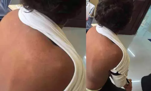 സ്കൂൾ ഗ്രൗണ്ടിൽ കളിക്കുന്നതിനിടെ വിദ്യാർഥിക്ക് സൂര്യാതപമേറ്റു