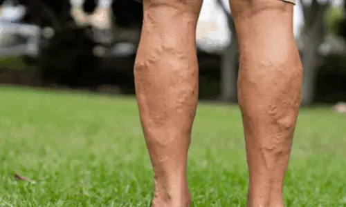 ശ്രദ്ധിക്കണം വെരിക്കോസ് വെയ്ന്‍