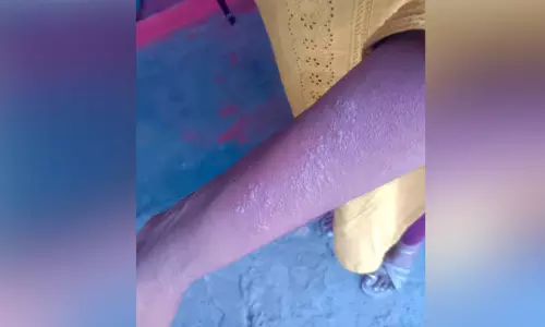 വേനല്‍ കടുത്തു; കുളത്തൂപ്പുഴയില്‍ സൂര്യാതപത്തില്‍ വീട്ടമ്മക്ക് പൊള്ളലേറ്റു