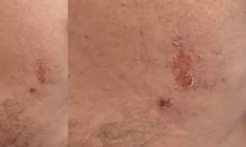 ഉഷ്‌ണതരംഗം: ചങ്ങരംകുളത്ത് യുവാവിന് സൂര്യാതാപമേറ്റു