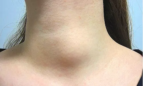 കഴുത്തിൽ വേദനയില്ലാത്ത മുഴകളാണോ? അവഗണിക്കരുത്, വേദനയുള്ളതിനേക്കാൾ അപകടമായേക്കാം